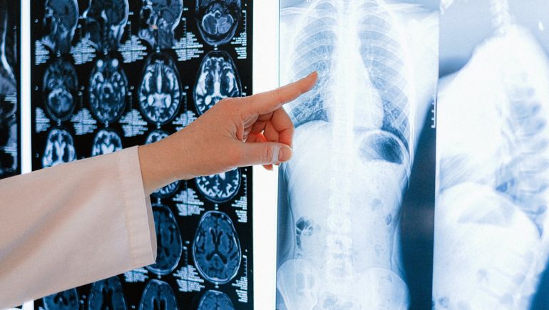 GE HealthCare gets 510(k) clearance for algorithm to detect collapsed lungs