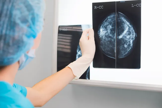 Advamed asks CMS to cover extra imaging of dense breast tissue